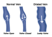 Spider Vein Disease Treatment at Marylad Heart